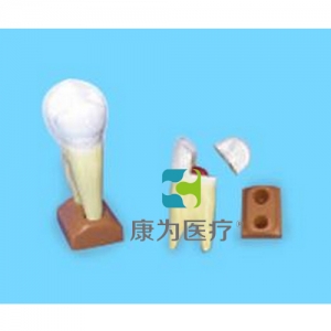 “康為醫(yī)療”上頜兩根齲齒模型(2部分，放大)