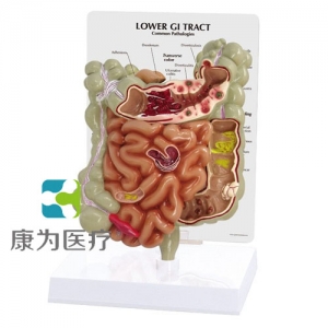 “康為醫(yī)療”醫(yī)患關(guān)系溝通模型-病理大、小腸模型（醫(yī)學(xué)指導(dǎo)模型）