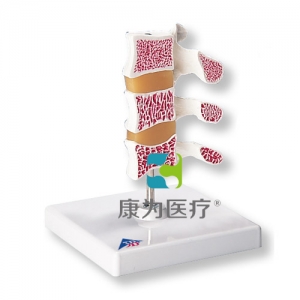 豪華型骨質(zhì)疏松癥模型，3塊椎骨