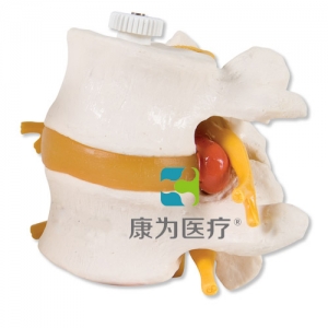 帶椎間盤脫出的2塊腰椎，活動(dòng)安裝