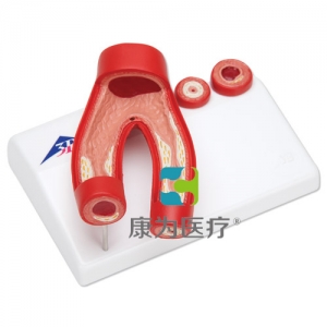 動(dòng)脈硬化模型，帶動(dòng)脈切面，2部分